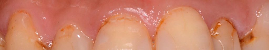 歯の根元の写真