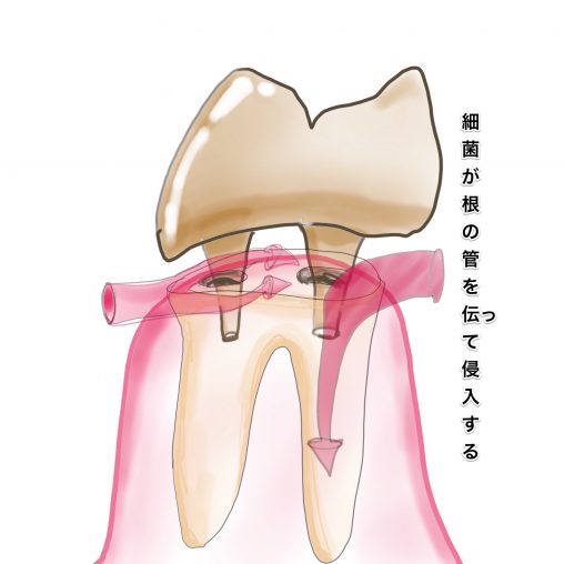 仮歯から細菌が入り込む図