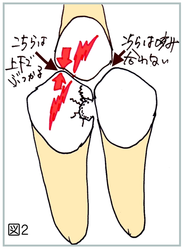 噛み合わせで歯にヒビが入る図